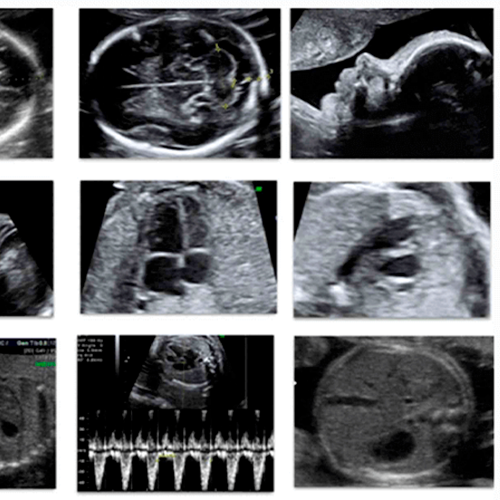Ecografa de detalle Anatmico