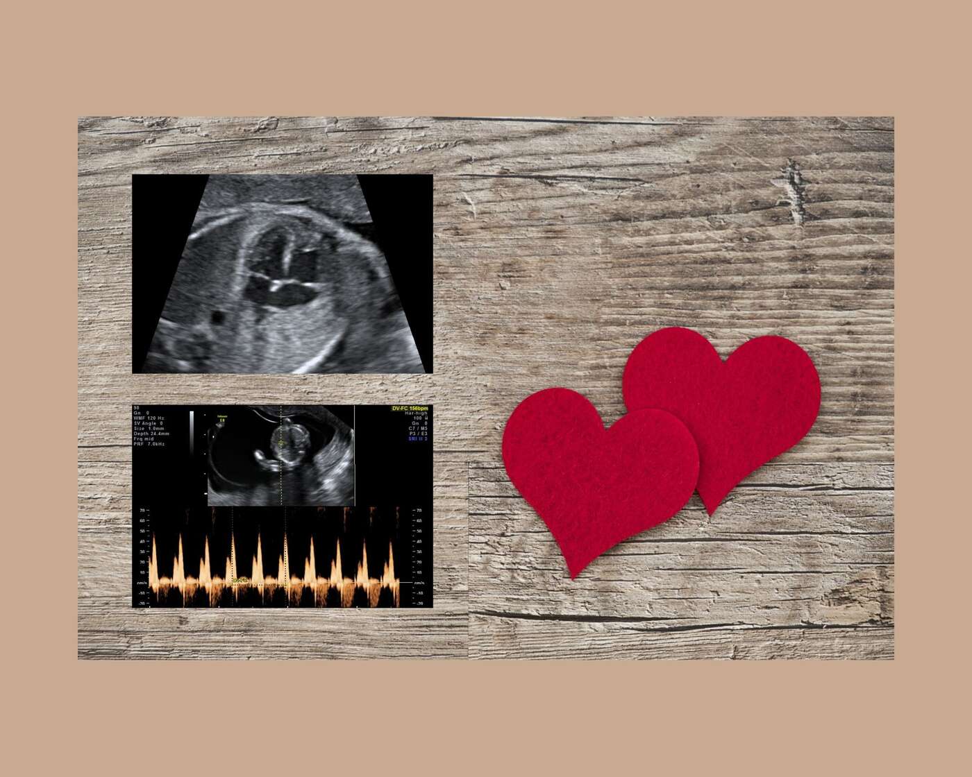 Imagen de Ecocardiografia fetal