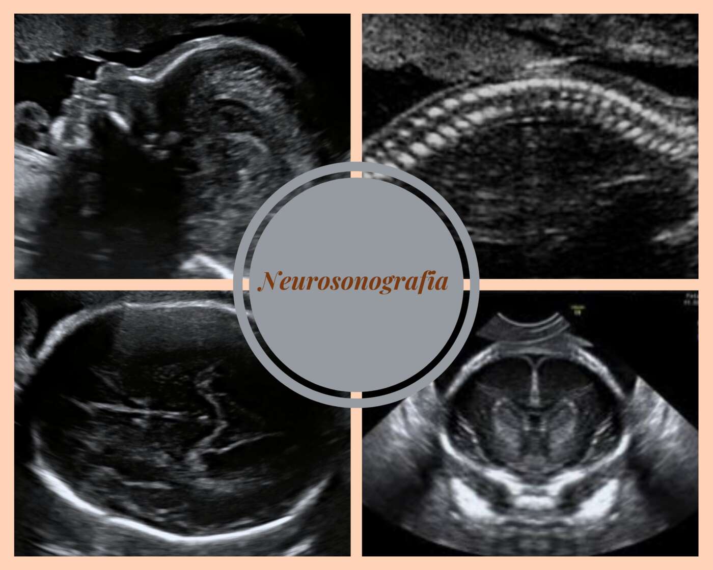 Imagen de Neurosonografía fetal