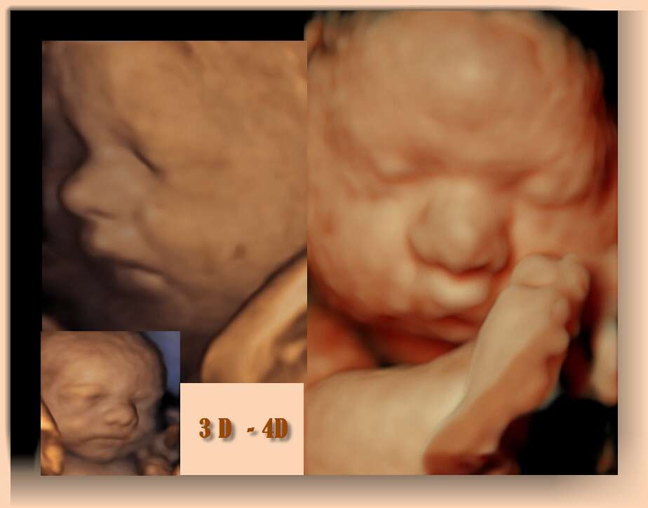 Imagen de Ecografía 3D - 4D